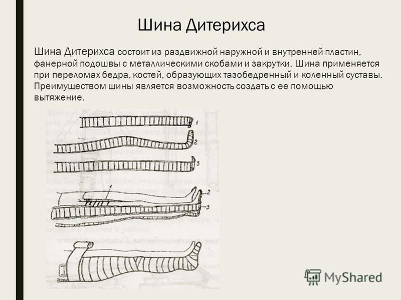 Шина при переломах голени и бедра: как накладывается, …