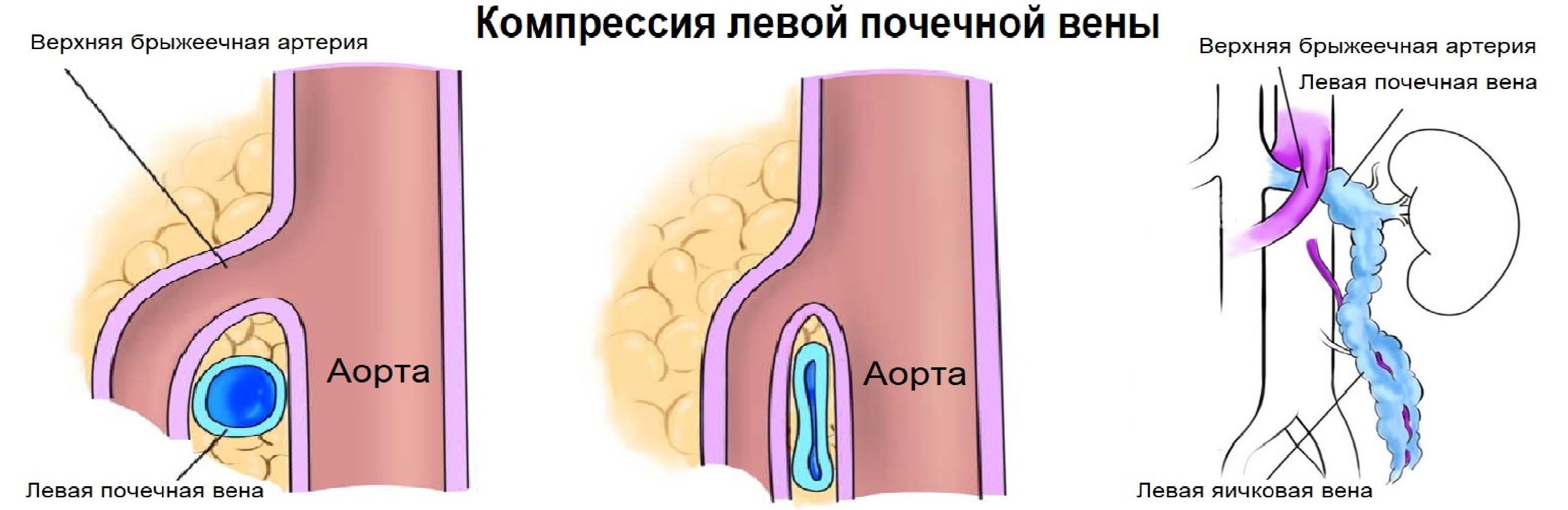 Расширение семенной вены. Синдром сдавления левой почечной вены. Компрессия левой почечной вены. Аорто-мезентериальной компрессии левой почечной вены.. Стентирование левой почечной вены.